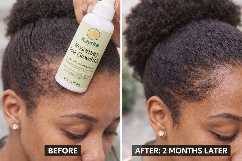 Best Rosemary Oil for Hair Growth in Canada (2026 Guide for Thicker, Healthier Hair)